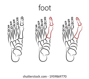 Human Foot. Improper Bone Fusion. Symbol. Vector Illustration.