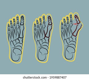 Human Foot Improper Bone Fusion Vector Stock Vector (Royalty Free ...