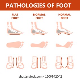 Human foot pathologies infographic. Flat foot anatomy. Deformed and healthy footprint. Illness therapy. Isolated vector illustration in cartoon style