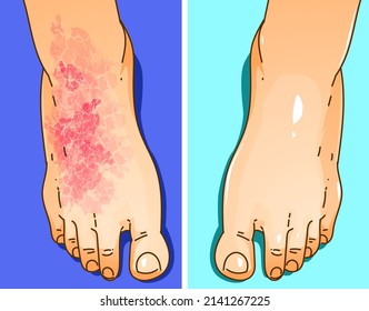 The human foot with skin disease. Itching, scabies. Before, after. Healthcare illustration. Vector illustration.