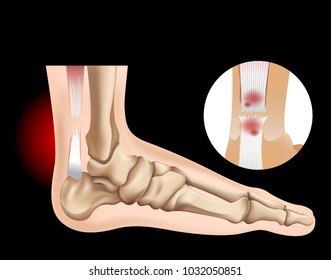 Human foot with tear tendon illustration