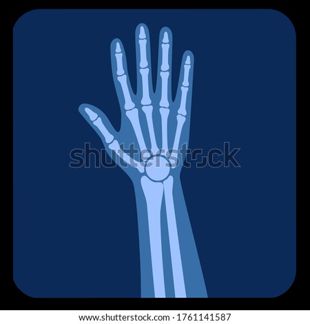 Human forearm anatomy, x ray view. Wrist and Hand Bones on reontgen. Vector illustration isolated on white background. skeletal system silhouette. Medical, educational and science banner