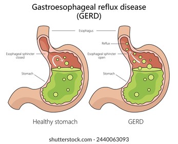 Strukturdiagramm der humanen gastroösophagealen Refluxkrankheit, handgezeichnete schematische Vektorgrafik. Medizin-Bildungs-Illustration