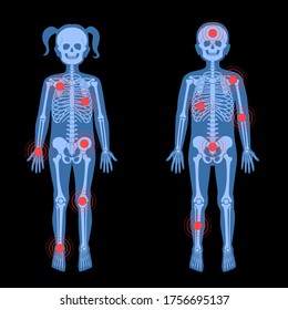 Human Girl And Boy Skeleton Pain, Fracture Or Inflammation On X Ray View. Vector Isolated Flat Illustration Of Children Skull And Bones In Female And Male Body. Medical Or Educational Banner.