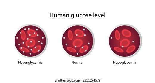 Human Glucose Level Hyperglycemia Normal Hypoglycemia Stock Vector 