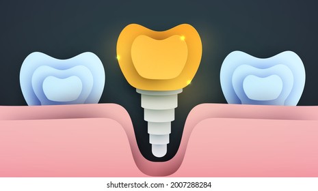 Human golden tooth implant silhouette in modern creative style. Luxury minimalistic design concept. Premium healthcare medical composition art element. Bright paper cut layer vector illustration.