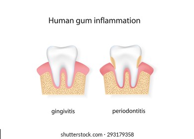 Human gum inflammation.