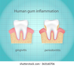 Human gum inflammation.