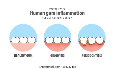 Human gum inflammation in circle illustration vector on white background. Dental concept.