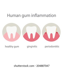 Human gum inflammation. EPS 10 vector file.