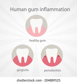 Human gum inflammation. EPS 10 vector file.
