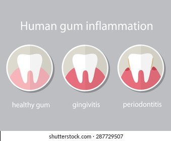 Human gum inflammation. EPS 10 vector file.