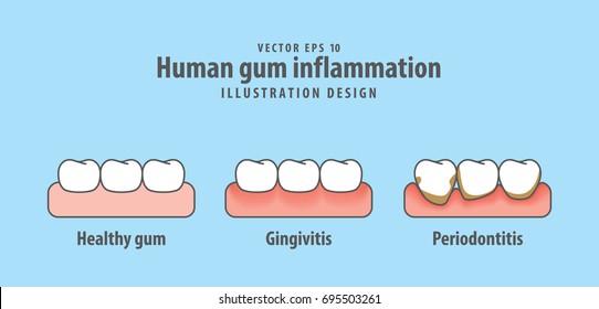 Human gum inflammation illustration vector on blue background. Dental concept.