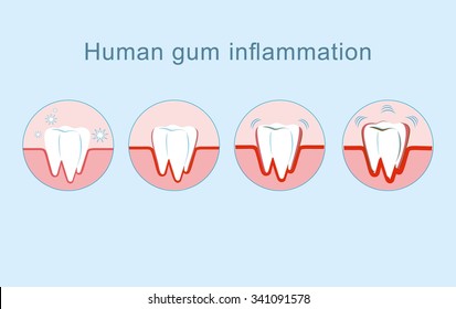 Human gum inflammation - vector illustration.