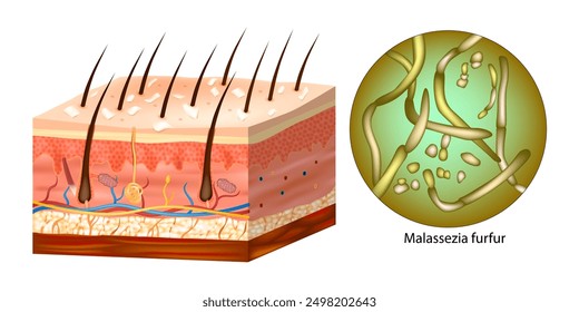 Human hair with dandruff of microscopic fungi Malassezia furfur that cause dandruff and seborrhoeic dermatitis. 