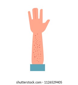 Human hand affected small red rash - symptom of allergy or eczema isolated on white background. Dermatologic disease of skin on arm - atopic dermatitis health in flat vector illustration.