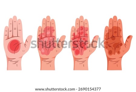 Human hand burn illustration vector showing different degrees ideal for first aid fire or chemical injury visual educational and health safety materials