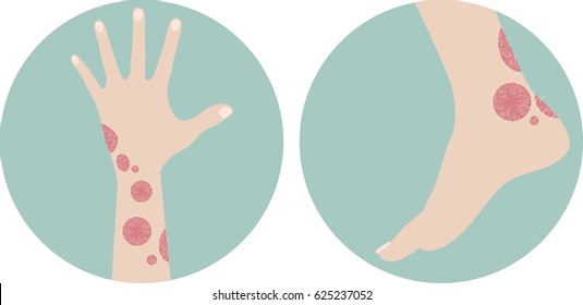 Human hand and leg with psoriasis illustration