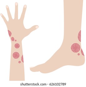 Human hand and leg with psoriasis illustration