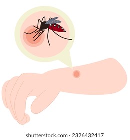 La mano humana con la picadura de un mosquito. El mosquito pega mano. Picadura de mosquito. Ilustración sanitaria.