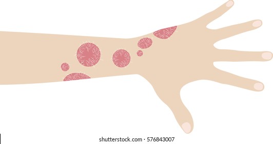 Human hand with psoriasis illustration