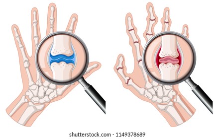 A Human Hand With Rheumatoid Arthritis Illustration