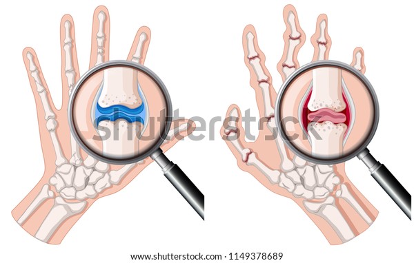 関節リウマチのイラストを持つヒトの手 のベクター画像素材 ロイヤリティフリー