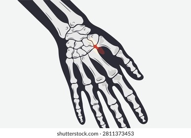 Human hand skeletal diagram with a highlighted red area indicating joint pain or injury in the wrist and thumb area.
