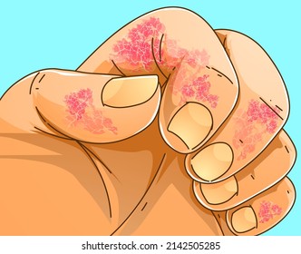 The human hand with skin disease. Itching, scabies. Healthcare illustration. Vector illustration.