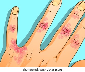 The human hand with skin disease. Itching, scabies. Healthcare illustration. Vector illustration.