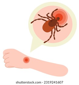 The human hand with the tick bite. Tick bite hand.Tick bite. Healthcare illustration.