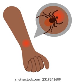 La mano humana con la garrapata mordida. Marcar la mano. Morder. Ilustración sanitaria.