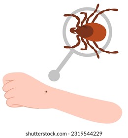 The human hand with the tick bite. Tick bite hand.Tick bite. Healthcare illustration.