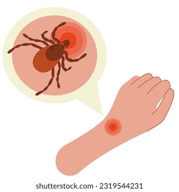The human hand with the tick bite. Tick bite hand.Tick bite. Healthcare illustration.