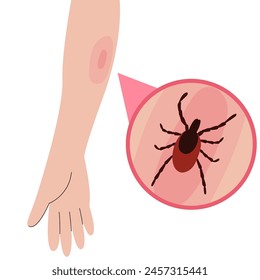 La mano humana con la picadura de garrapata. Mano con picadura de garrapata. Ilustración sanitaria.