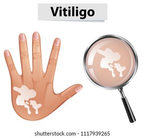 Human Hand and Vitiligo illustration
