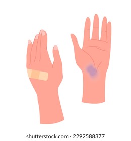 Human hands with band aid, bruise on palm, infographic vector illustration. Cartoon isolated two broken hands after injury or accident damage, medical adhesive tape for treatment of cut on arms skin