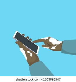 Human hands close-up affected by the Skin Disease Vitiligo use a smartphone. A dark-skinned man with vitiligo. Communication technologies. Vector illustration isolated on a white background.