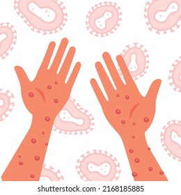 Human hands with monkeypox virus on the microscopic background of the virus. Vector flat hand drawn illustration of monkey pox. Virus symptoms of skin infection.