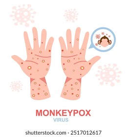Manos humanas con síntomas del virus de la viruela símica