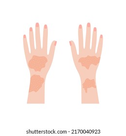 Human hands with psoriasis and rashes. Red eczema eruptions and inflamed eczema. Allergic urticaria problems and infectious vector smallpox infection
