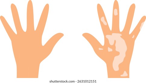 Human Hands with Vitiligo Skin Condition