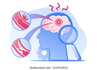 Cabeza humana con enfermedad cerebral, aterosclerosis, hemorragia y dolor. Ilustración de concepto médico de infografía plana vectorial. Diseño para afiches, impresión, fondo, página de inicio