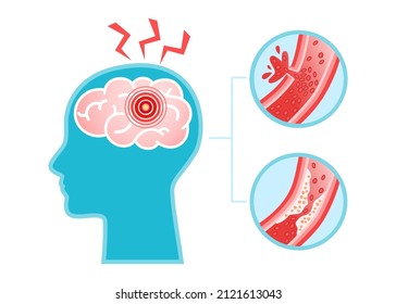 Human head with brain stroke disease, atherosclerosis, hemorrhage and pain point. Vector flat infographic medical concept illustration. Design for poster, print, background, landing page