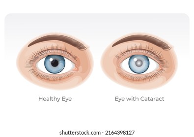 Human Healthy Eye and Eye with Cataract - Illustration as EPS 10 File svg