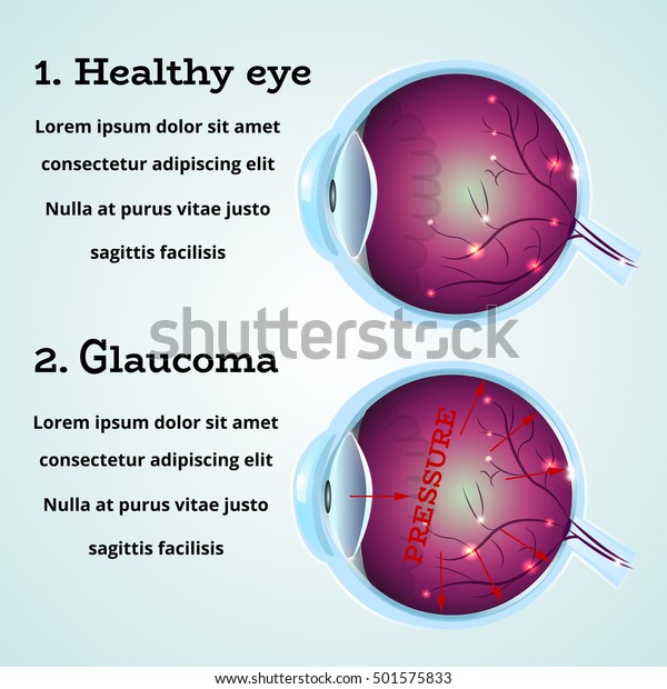 Estructura De Anatomía De La Enfermedad De Los Ojos Y Del Glaucoma Para La Salud Humana 3161