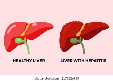 human healthy liver and human liver with hepatitis