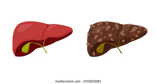 Human healthy and unhealthy fatty liver set isolated on white background. Medical or education concept. Healthy and pathology human organ. Vector illustration.