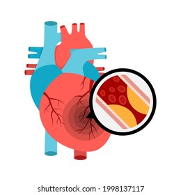 Human Heart Anatomy With Heart Attack. Atherosclerotic Plaque In The Blood Vessels.