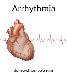 Human Heart Arrhythmia Anatomy Illustration Red Stock Vector (Royalty ...